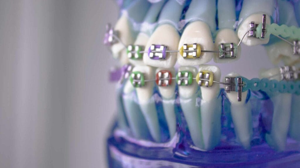 Come raddrizzare i denti senza apparecchio