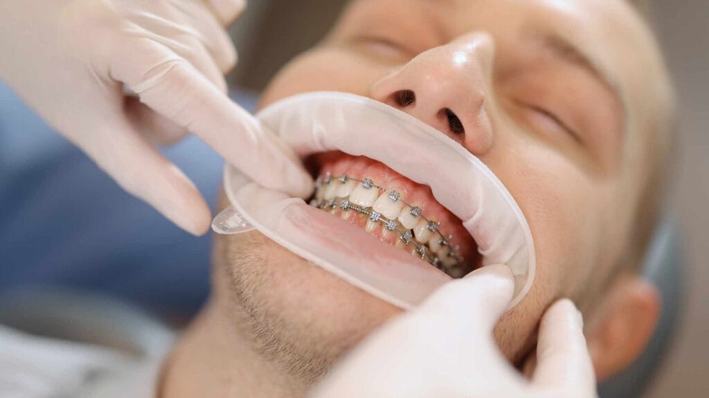 come lavare i denti con l'apparecchio tecniche
