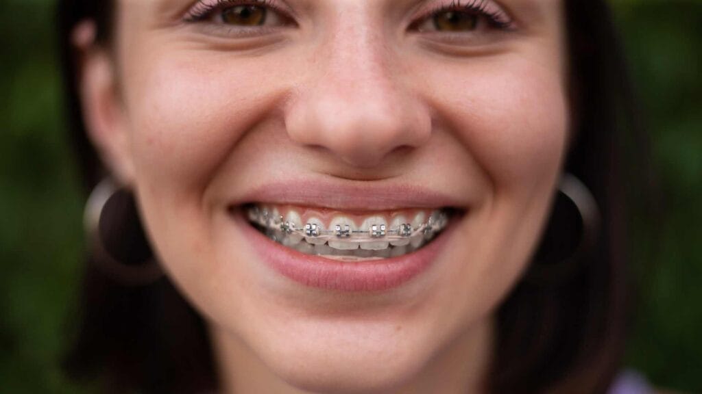 come lavare i denti con l'apparecchio - ortodonzia