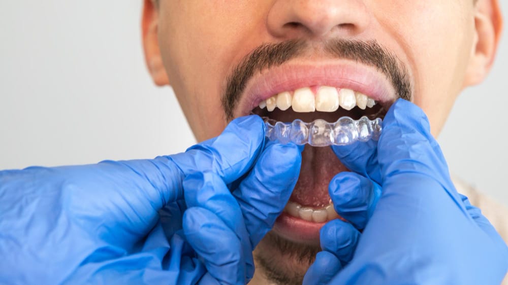 apparecchio denti prima e dopo