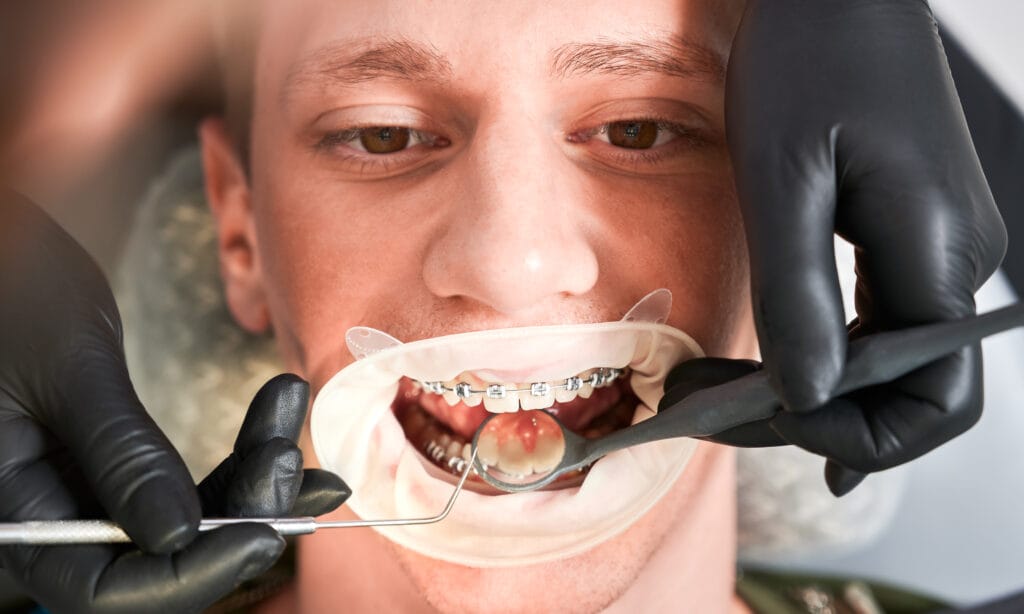 apparecchio dentale per adulti