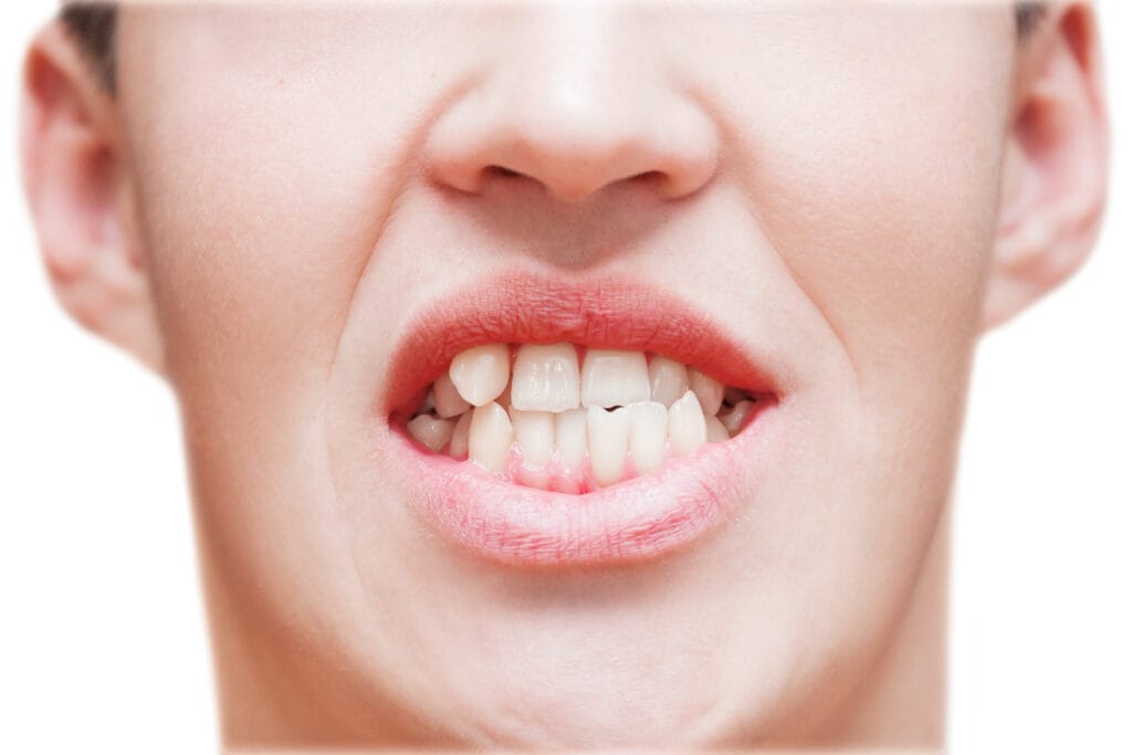 apparecchio denti prima e dopo